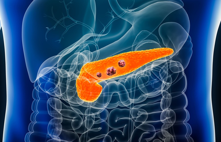 Image: New research brings hope for improved early detection of pancreatic cancer (Photo courtesy of 123RF)