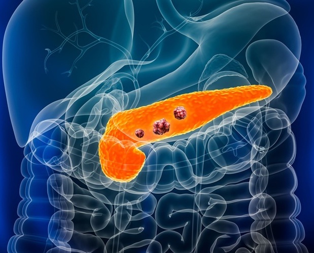 Image: New research brings hope for improved early detection of pancreatic cancer (Photo courtesy of Adobe Stock)
