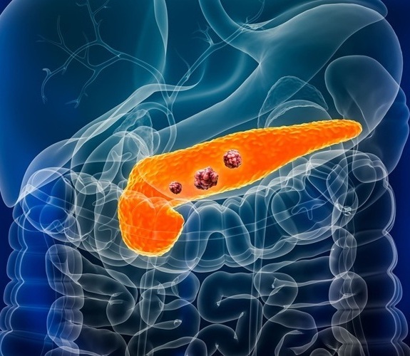 Image: New research brings hope for improved early detection of pancreatic cancer (Photo courtesy of Adobe Stock)