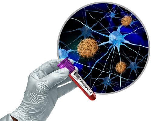 Image: Brain biomarkers of Alzheimer\'s disease can be detected as early as middle age (Photo courtesy of University of Shutterstock)