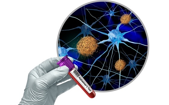 Image: Brain biomarkers of Alzheimer\'s disease can be detected as early as middle age (Photo courtesy of University of Shutterstock)