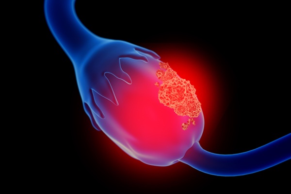 Image: The discovery of early markers for ovarian cancer that would have improved sensitivity could aid detection (Photo courtesy of Adobe Stock)
