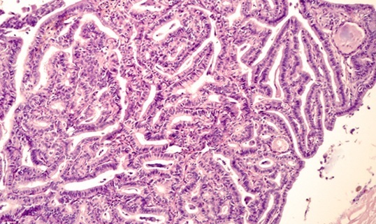Image: The AI-powered framework identifies critical transitions and classifies thyroid cancer subtypes (Photo courtesy of Shutterstock)