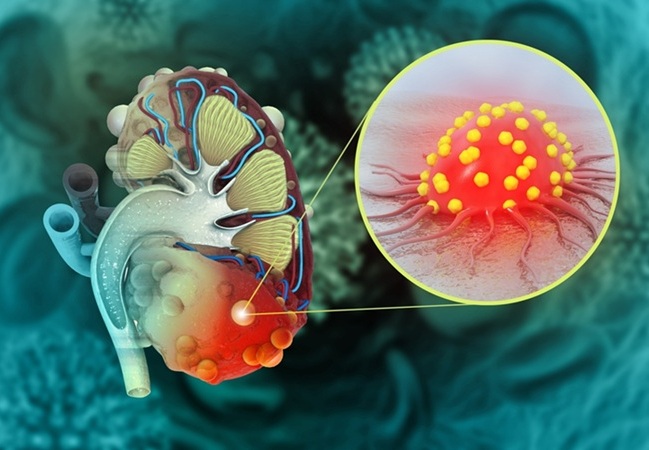 Image: Researchers have discovered 29 proteins that are linked to how quickly kidney function declines in patients with ADPKD (Photo courtesy of Shutterstock)