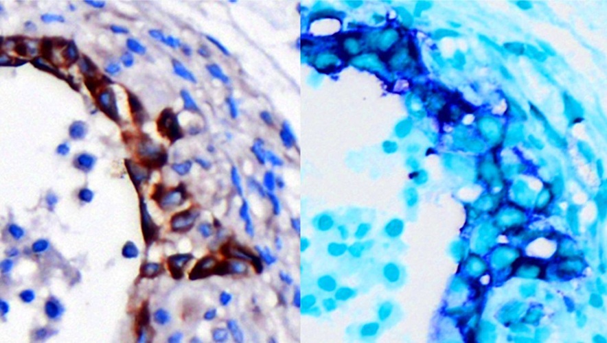 Image: Pancreas cells (left) showing early stages of malignant cancer in brown and same cells stained blue (right) indicate they are Integrin β3 (ITGB3) positive (Photo courtesy of UC San Diego Health Sciences)
