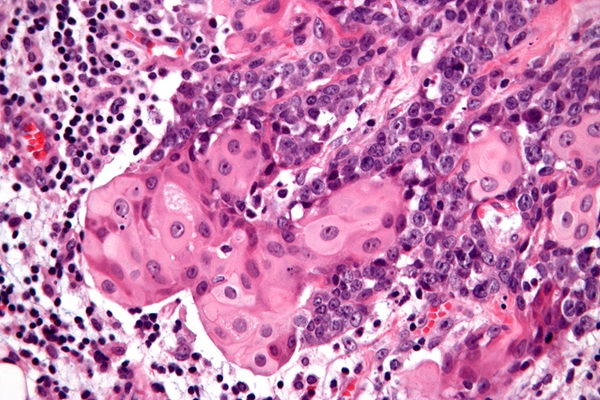 Image: The diagnosis of NUT carcinoma should include additional testing capable of detecting gene fusions specific to the disease (Nephron, CC BY-SA 3.0, via Wikimedia Commons)