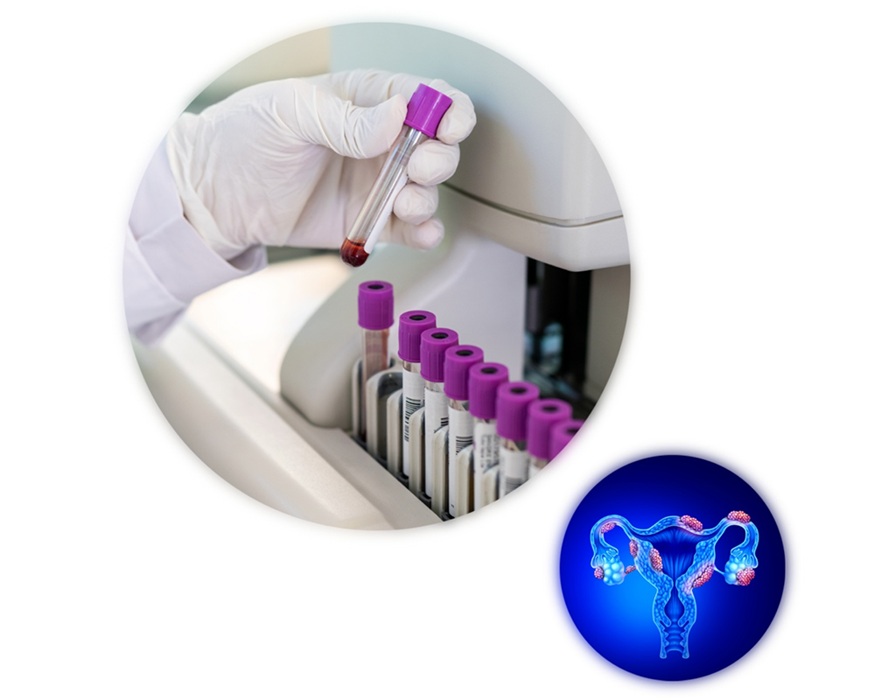 Image: The test combines an immunoassay on a patient’s blood sample with clinical information in a diagnostic algorithm (Photo courtesy of Kephera Diagnostics)