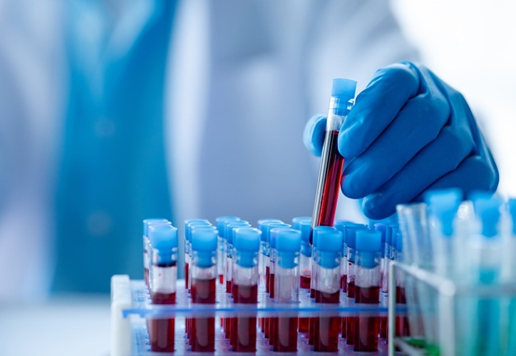 Image: Standard blood tests could be easily adapted into population-level screening tool for COPD (Photo courtesy of Adobe Stock)