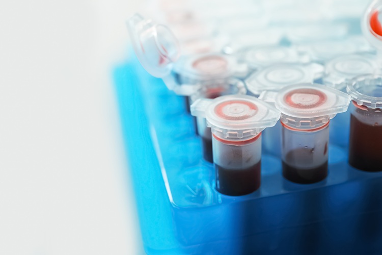 Image: A simple blood sample that allows DNA methylation could identify epigenetic biomarkers (Photo courtesy of 123RF)
