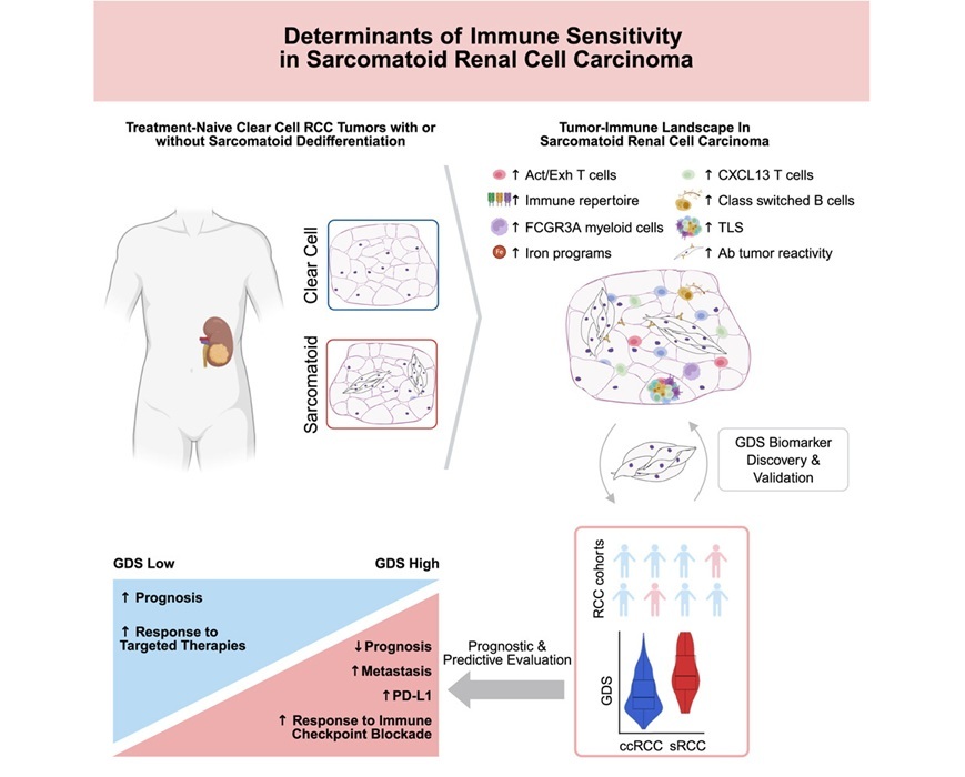 Image: Insights into sarcomatoid renal cell carcinoma point to broader use of common immunotherapies (Photo courtesy of Salgia NJ et al., Cancer Cell, 2025)