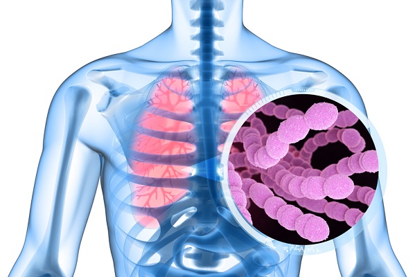 Image: The advanced test enables early, definitive detection of respiratory infections and pneumonia in critically ill patients (Photo courtesy of Shutterstock)
