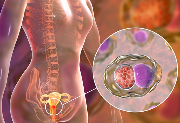 Image: New diagnostics could predict a woman’s risk of a common sexually transmitted infection (Photo courtesy of 123RF)