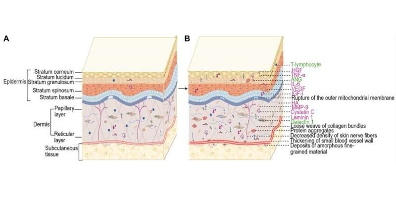 Image: (A) Normal skin and (B) possible pathology in ALS skin (Photo courtesy of Biomolecules and Biomedicine (2025) DOI: 10.17305/bb.2025.12100)