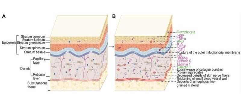 Image: (A) Normal skin and (B) possible pathology in ALS skin (Photo courtesy of Biomolecules and Biomedicine (2025) DOI: 10.17305/bb.2025.12100)