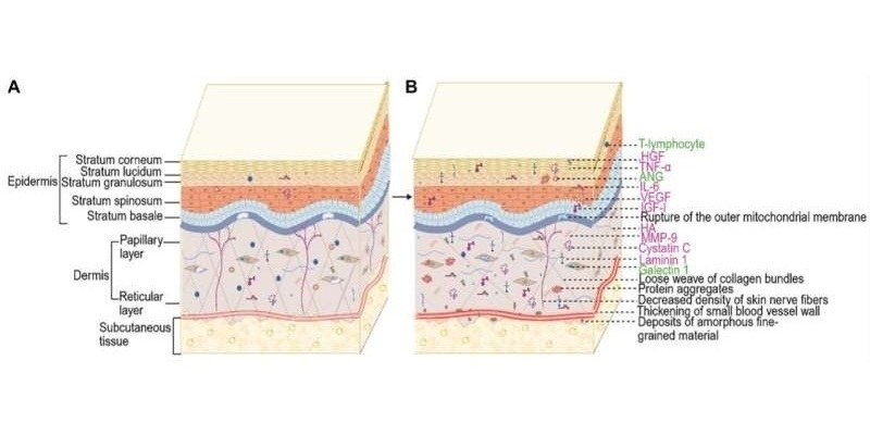 Image: (A) Normal skin and (B) possible pathology in ALS skin (Photo courtesy of Biomolecules and Biomedicine (2025) DOI: 10.17305/bb.2025.12100)