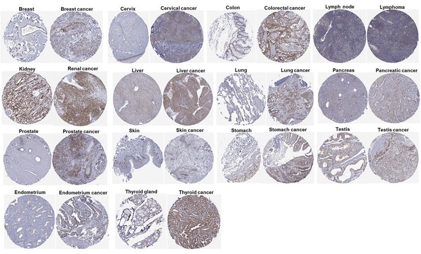 Image: Immunohistochemical staining shows CISD1 protein expression in normal human tissues and corresponding cancers (Li, C. et al., Genes & Diseases 2025; doi.org/10.1016/j.gendis.2025.101677)