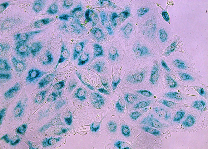 Image: Breast cancer cells in their ’sleeping’ state (senescence) after treatment (Photo courtesy of Garvan Institute of Medical Research)