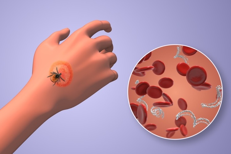 Image: The single-tier test showed >90% sensitivity in early Lyme disease patients (Photo courtesy of Shutterstock)