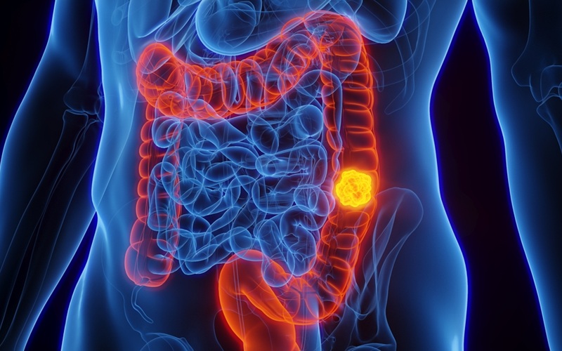 Image: AI can detect colorectal cancer using gut bacteria (Photo courtesy of Shutterstock)