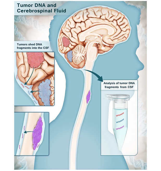 Image: The multi-analyte test can accurately identify brain cancers using small samples of cerebrospinal fluid (Photo courtesy of Elizabeth Cook)