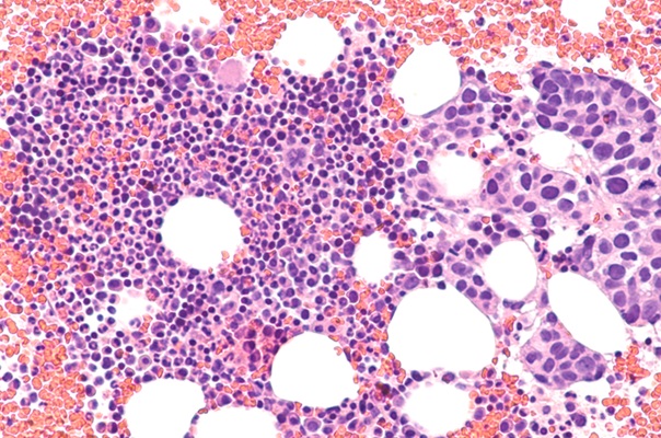 Image: Dormant tumor cells evade imaging tests and may later reactivate to spread metastatic breast cancer (Photo courtesy of David A. Litman/Shutterstock)
