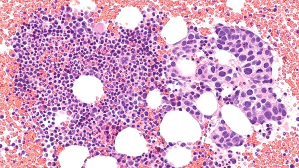 Image: Dormant tumor cells evade imaging tests and may later reactivate to spread metastatic breast cancer (Photo courtesy of David A. Litman/Shutterstock)