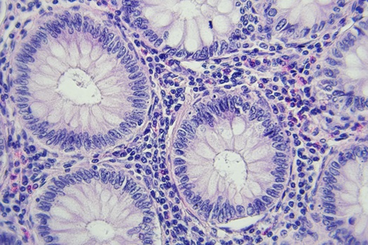 Image: Colorectal cancer under the microscope (Photo courtesy of Adobe Stock)