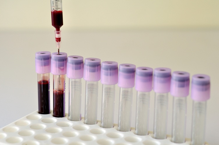 Image: Blood tests are emerging as a potential diagnostic tool for Alzheimer\'s disease (Photo courtesy of 123RF)