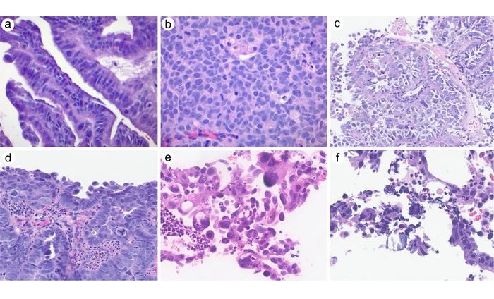 Image: High-grade serous carcinomas identified in cervical biopsies (Photo courtesy of Tong Sun)