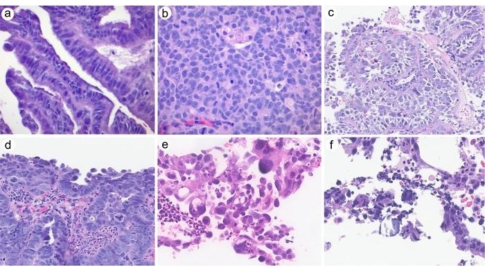 Image: High-grade serous carcinomas identified in cervical biopsies (Photo courtesy of Tong Sun)