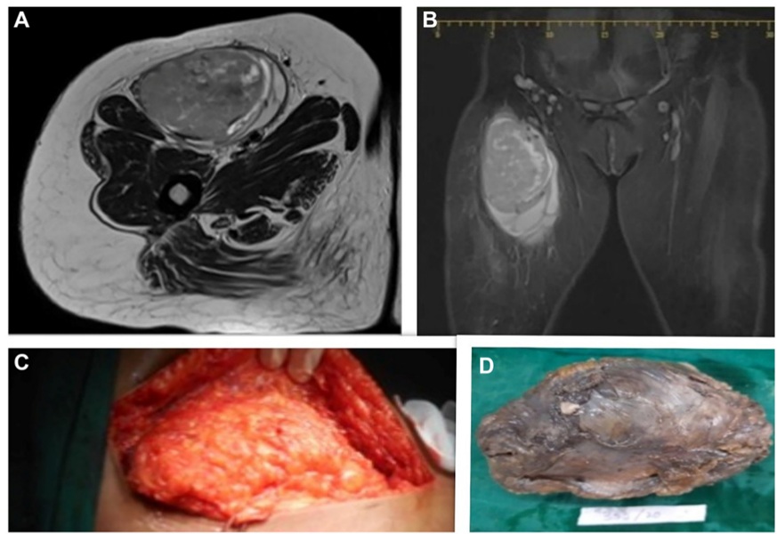 Image: An adult fibrosarcoma case report has shown the importance of early diagnosis and targeted therapy (Photo courtesy of Sultana and Sailaja/Oncoscience)