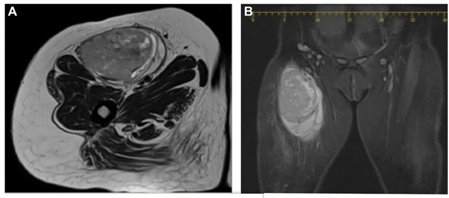 Image: An adult fibrosarcoma case report has shown the importance of early diagnosis and targeted therapy (Photo courtesy of Sultana and Sailaja/Oncoscience)
