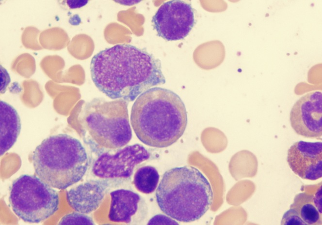 Image: The trial will evaluate whether blood-based single-cell sequencing can reliably diagnose conditions such as Myelodysplastic Syndromes (Photo courtesy of Shutterstock)