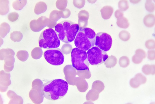 Image: The new diagnostic tool enables rapid leukemia subtype classification (Photo courtesy of Shutterstock)
