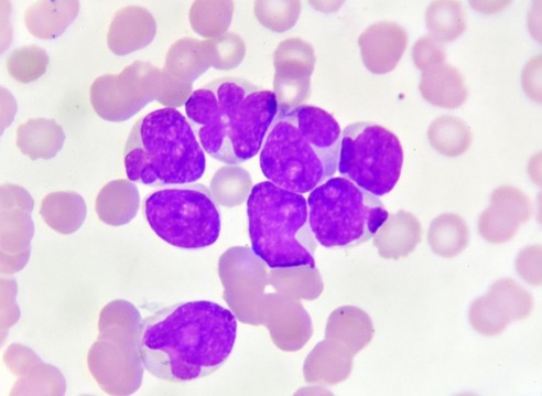 Image: The new diagnostic tool enables rapid leukemia subtype classification (Photo courtesy of Shutterstock)
