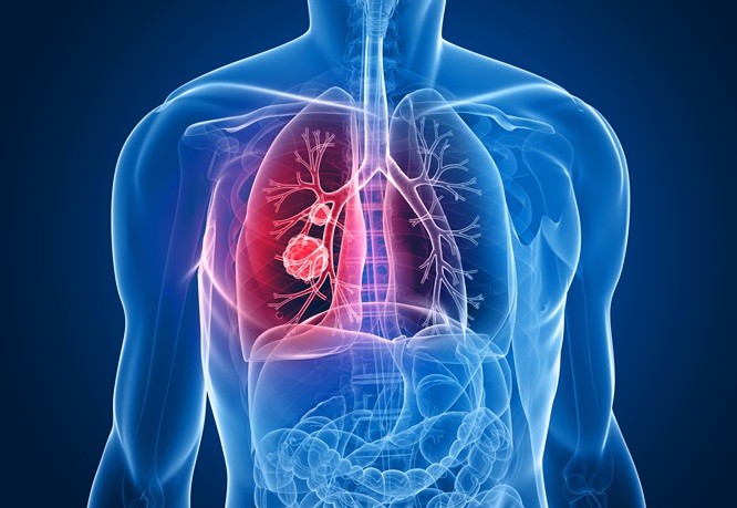 Image: LungCanSeek demonstrated an overall sensitivity of 83.5% and specificity of 90.3% in detecting lung cancer (Photo courtesy of AdobeStock)