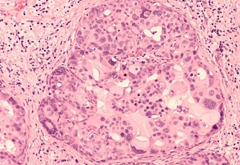 Image: Breast biopsy photomicrograph of ductal carcinoma in situ (DCIS)—The study’s findings could help refine treatment strategies for women with DCIS or LCIS (Photo courtesy of Shutterstock)