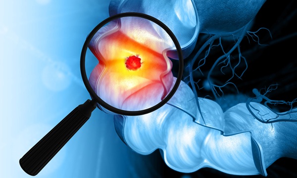 Image: The study found rural and nonrural patients have similar follow-up times after positive stool-based DNA tests (Photo courtesy of 123RF)