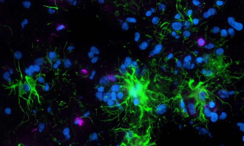 Image: This image shows how immune cells behave in glioblastoma after treatment with intracranial CAN3110 (Photo courtesy of Mass General Brigham)