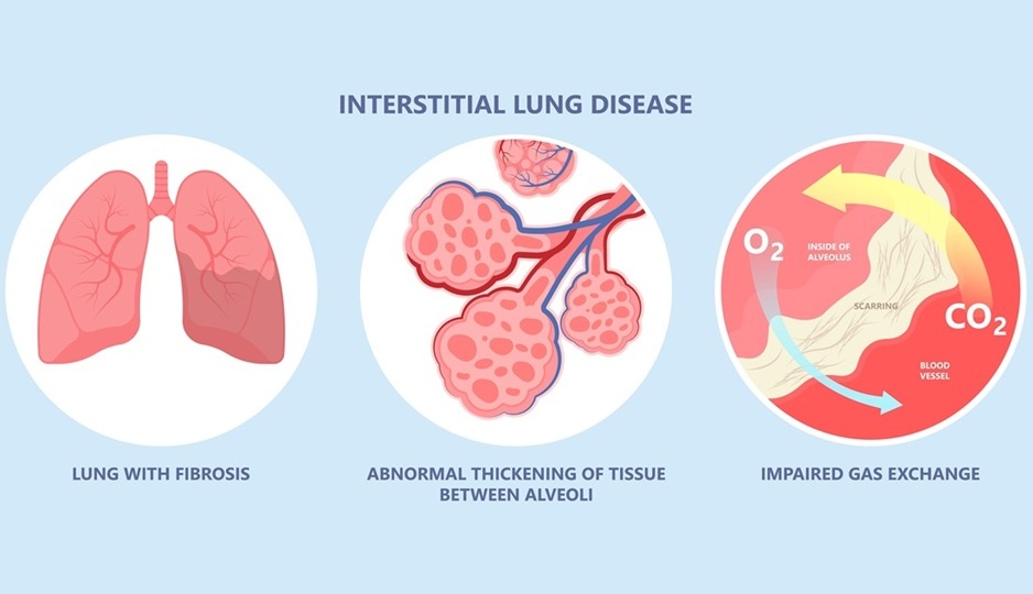 Image: Interstitial lung disease causes harmful scarring in the lungs that can require lung transplants (Photo courtesy of Shutterstock)