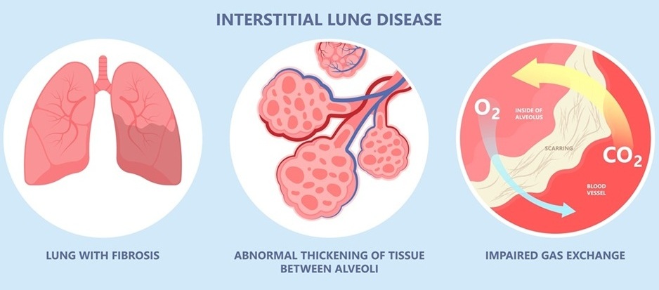 Image: Interstitial lung disease causes harmful scarring in the lungs that can require lung transplants (Photo courtesy of Shutterstock)