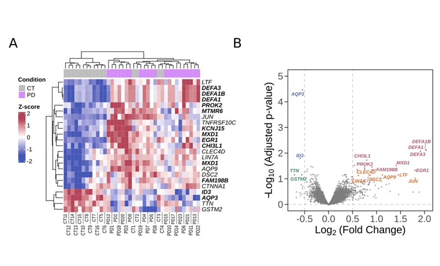 Image: Changes in gene expression in Parkinson’s disease. A) In red, increased gene expression; in blue, decreased expression. Genes with the most significant changes are shown in bold. B) Most significant upregulated genes in red, followed by pink, blue, and green, respectively (Photo courtesy of Navarrete, F. et al (2025). Neurotherapeutics, e00762)