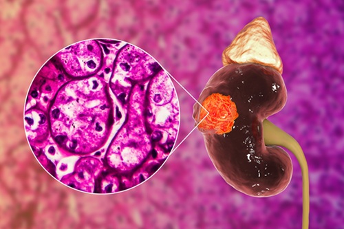 Image: Researchers have identified a key biomarker to improve renal cell carcinoma diagnosis (Photo courtesy of 123RF)