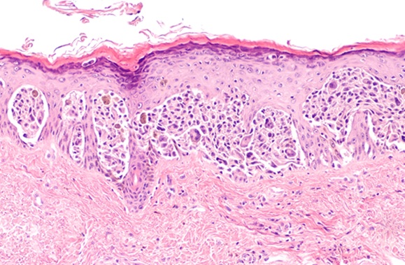 Image: The AI tool could make skin cancer diagnosis more accurate and equitable across all skin tones (Photo courtesy of 123RF)