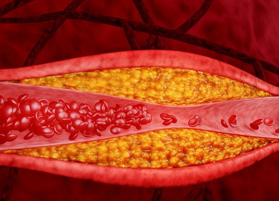 Image: A family history of heart disease is linked to a specific protein pattern in the blood (Photo courtesy of Adobe Stock)