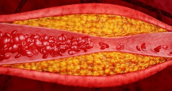 Image: A family history of heart disease is linked to a specific protein pattern in the blood (Photo courtesy of 123RF)