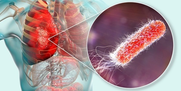 Image: New insights from a study link blood markers and airway bacteria to COPD exacerbation risk (Photo courtesy of Shutterstock)