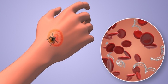 Image: The test detects Lyme-causing bacteria with far greater sensitivity than standard tests (Photo courtesy of Shutterstock)