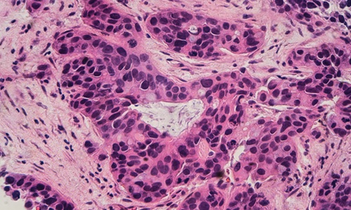 Image: The AI system is designed to mimic how human pathologists study cancer tissue by combining high-resolution cellular details with broader tissue context (Photo courtesy of Shutterstock)