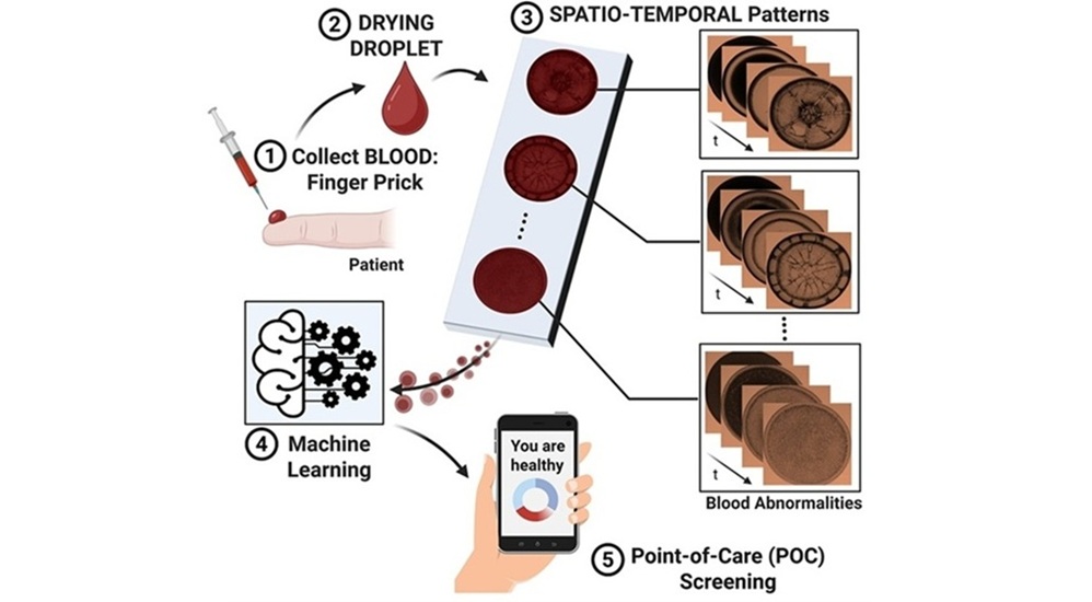 Image: The innovative diagnostic technology analyzes the full drying process of a blood droplet using machine learning (Photo courtesy of Anusuya Pal/The University of Tokyo)